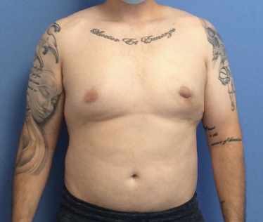 Gynecomastia-with-Liposuction | After Liposuction